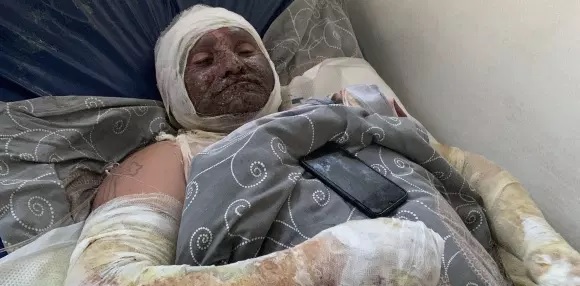 Burn victims of white phosphorus incendiary attacks by Azerbaijan on the Armenian-controlled Nagorno-Karabakh